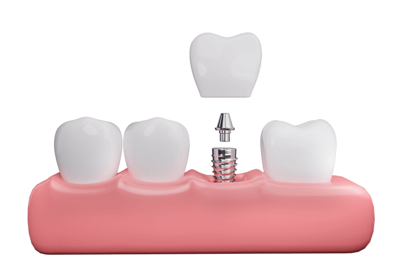 Zubni implantati